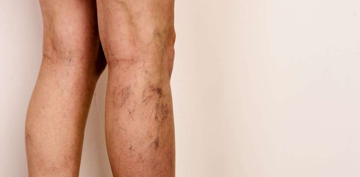 Vericose Veins tretment